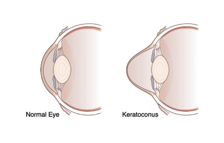 Keratoconus Eye Care in Chicago