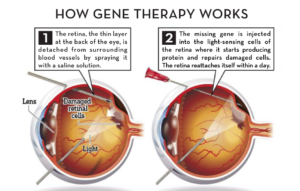 Gene Therapy eye care Chicago