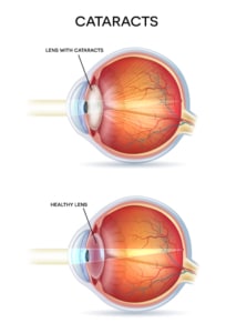 cataract treatment Chicago