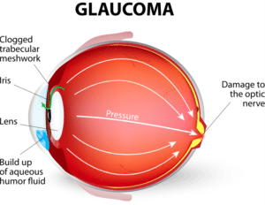 Second Leading Cause of Blindness | Glaucoma | Eye Doctor Chicago