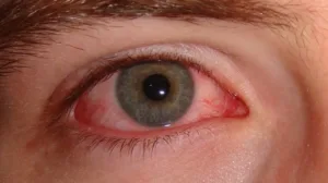 grass-dust-and-tree-pollen-may-cause-allergic-pink-eye-br-image-credit