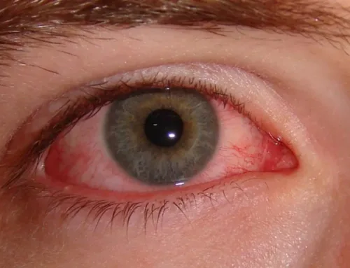 Understanding an Eye Doctors Role in Diagnosing and Treating Conjunctivitis (Pink Eye)