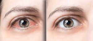 Eye Allergy