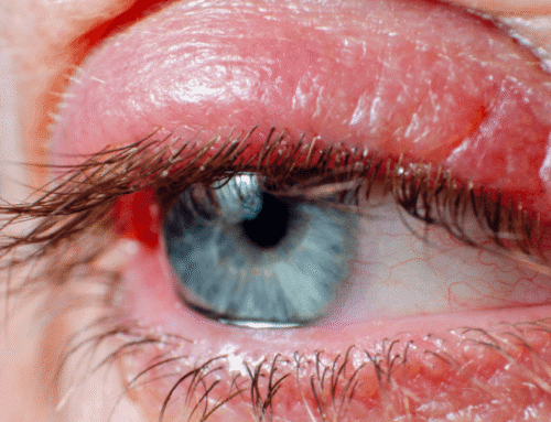 Demodex Blepharitis: Causes, Symptoms & Treatment