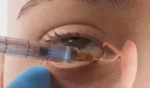 Lacrifill vs Punctal Plugs_ Dry Eye Treatment Guide