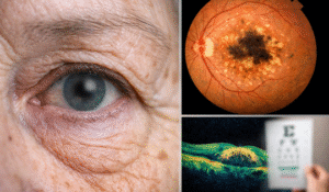 Age-Related Macular Degeneration_ Early Signs, the Amsler Grid & Treatment