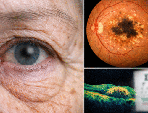 Macular Degeneration: Early Signs and Treatments