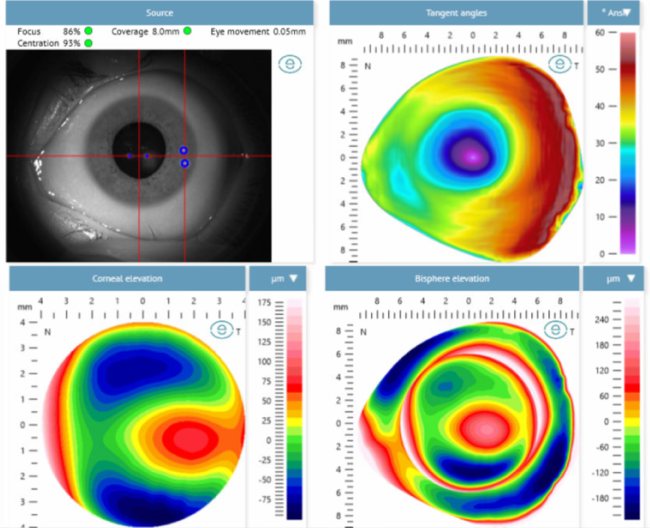 Corneal topography map of a keratoconus eye